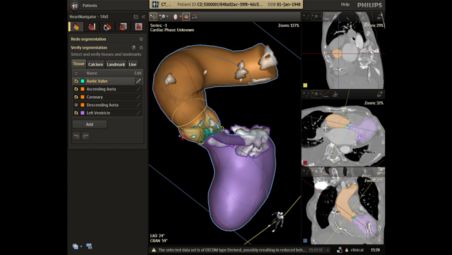 La visualisation des calcifications pour éviter les complications potentielles