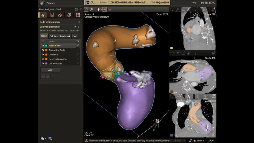 Calcification visualization to avoid potential complications