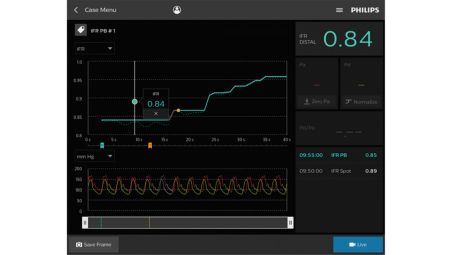 iFR reduces procedural time and costs per patient¹,²