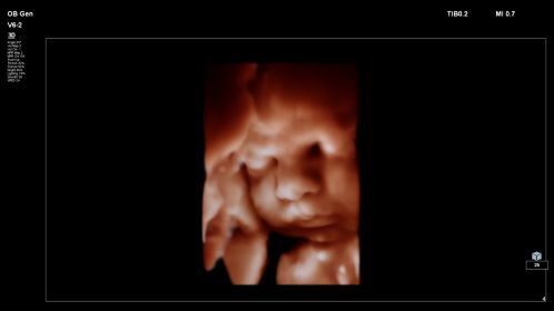 Fetal image shown with TrueVue on V6-2 transducer