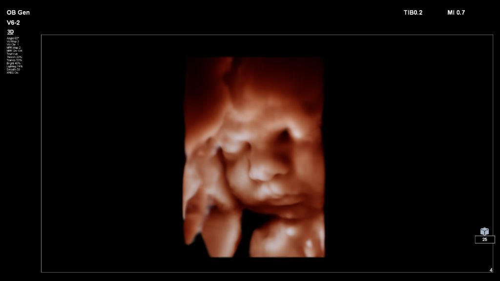 Fetal image shown with TrueVue on V6-2 transducer