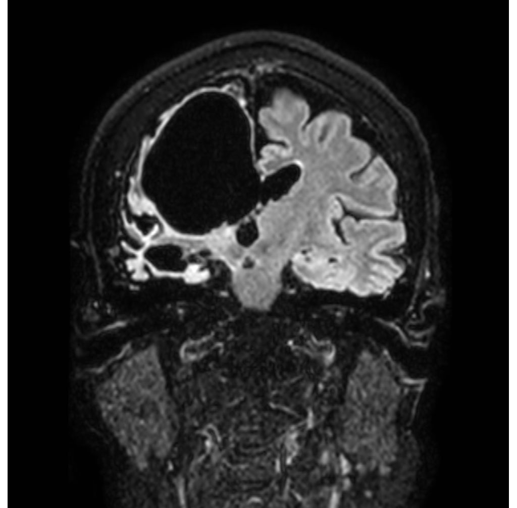 3D BrainVIEW FLAIR