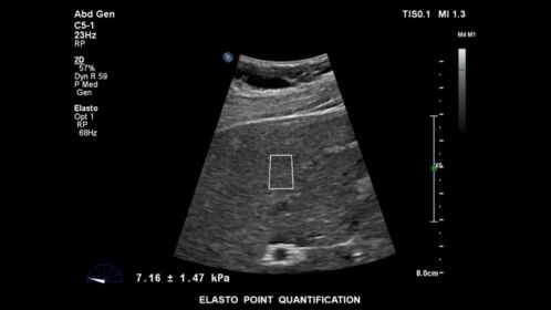 EPIQ ultrasound machine clinical image showing elastography point quantification 