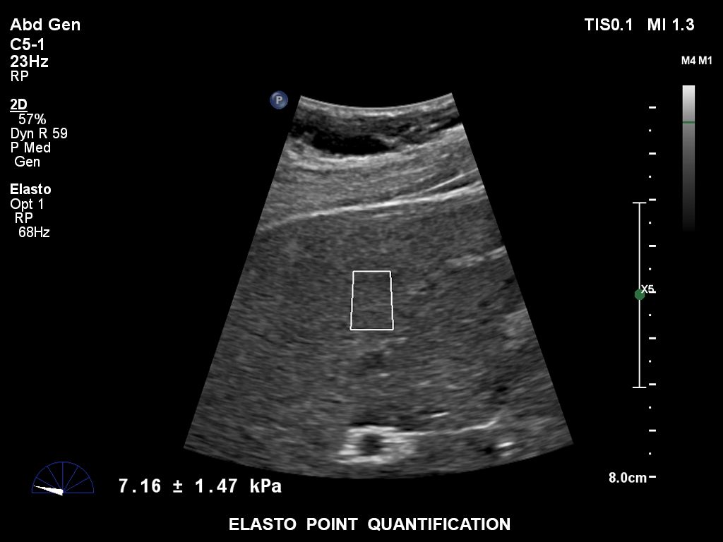 EPIQ ultrasound machine clinical image showing elastography point quantification 