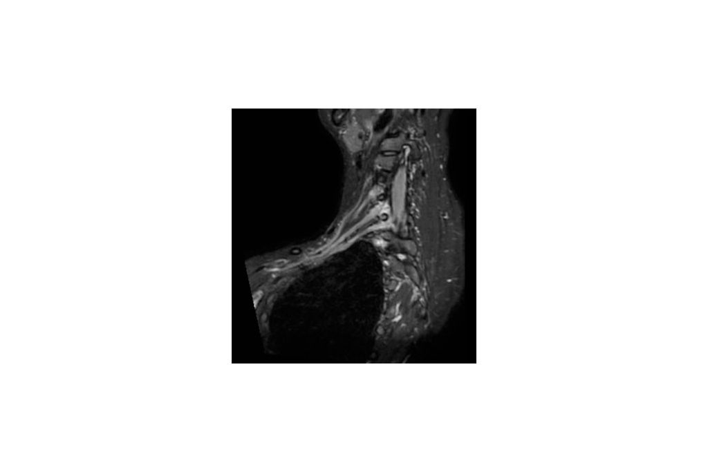 Coronal 3D STIR (oblique reformat) - HeadNeck