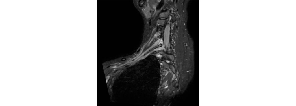 Coronal 3D STIR (oblique reformat) - HeadNeck