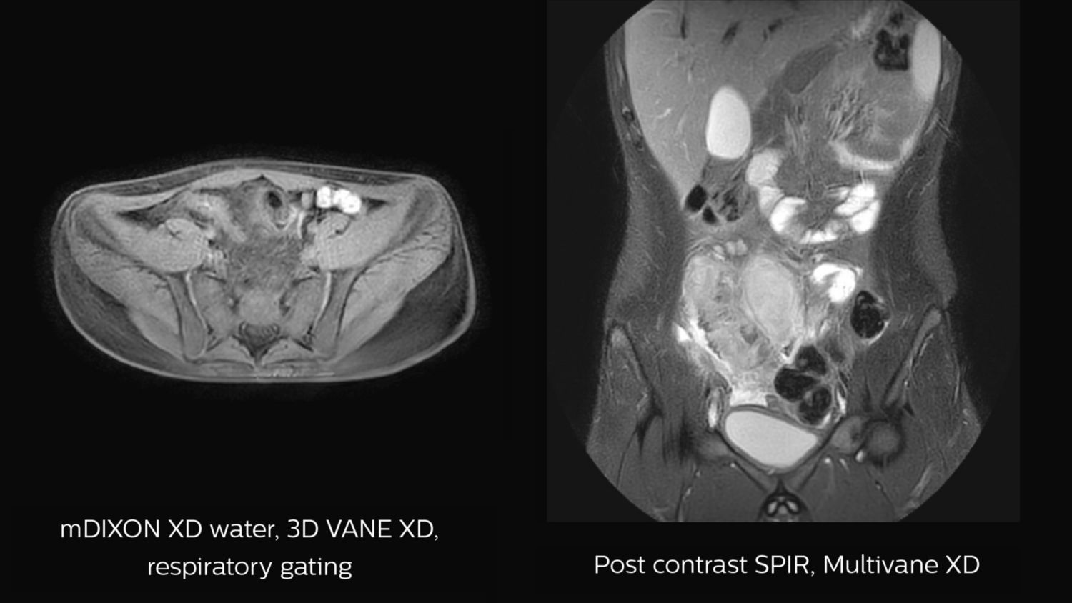 mDIXON XD , 3D VANE XD, MultiVane XD imaging of Crohn’s disease 