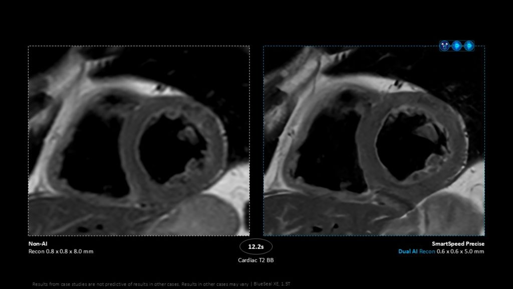 SmartSpeed Precise comparison – Cardiac
