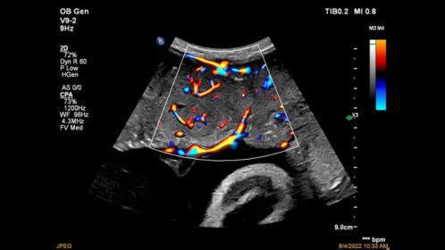 Placenta CPA with Flow Viewer