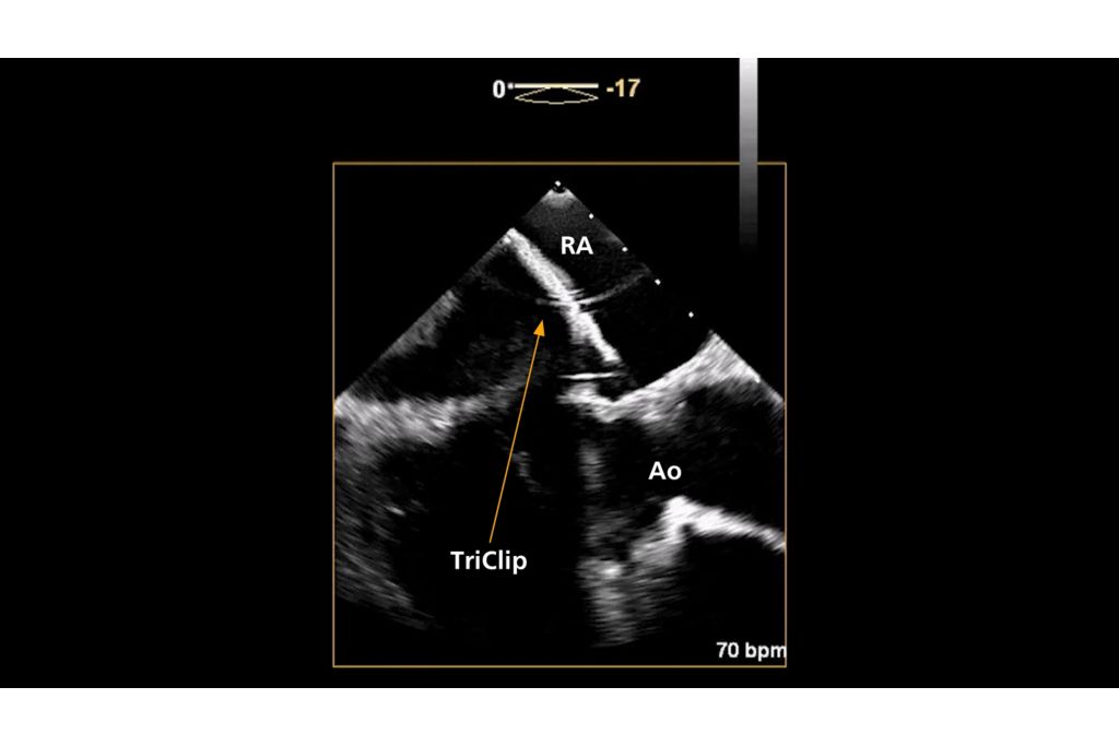 Visualizing TriClip device flexing towards the TV using elevation tilt