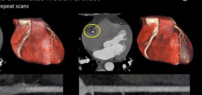 Imagen de tomografía computarizada espectral cardíaca de Philips que muestra reconstrucciones en 3D del corazón y una vista de sección transversal con una placa coronaria resaltada