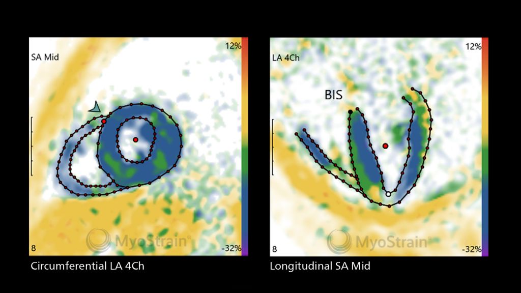 FAST-SENC MR images with MyoStrain analysis
