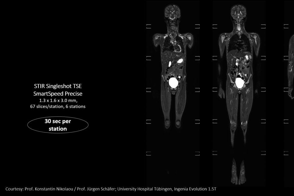 SmartSpeed Precise - Up to 3 times faster imaging. Preserve details in shorter scan times. Powered by Dual AI. 
Compared to Philips SENSE imaging. Dual AI: Reconstruction technology consisting of a first AI engine applied at the source of signal (Adaptive CS-NET) and a second AI engine applied on the raw complex imaging data (Precise Image Net).


