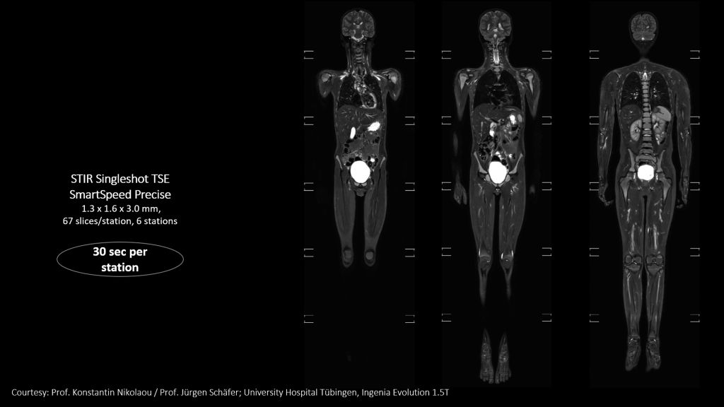 SmartSpeed Precise - Up to 3 times faster imaging. Preserve details in shorter scan times. Powered by Dual AI. 
Compared to Philips SENSE imaging. Dual AI: Reconstruction technology consisting of a first AI engine applied at the source of signal (Adaptive CS-NET) and a second AI engine applied on the raw complex imaging data (Precise Image Net).

