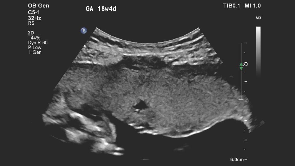 Figure 1 C5-1 transducer sagittal image of suspected placental abnormality