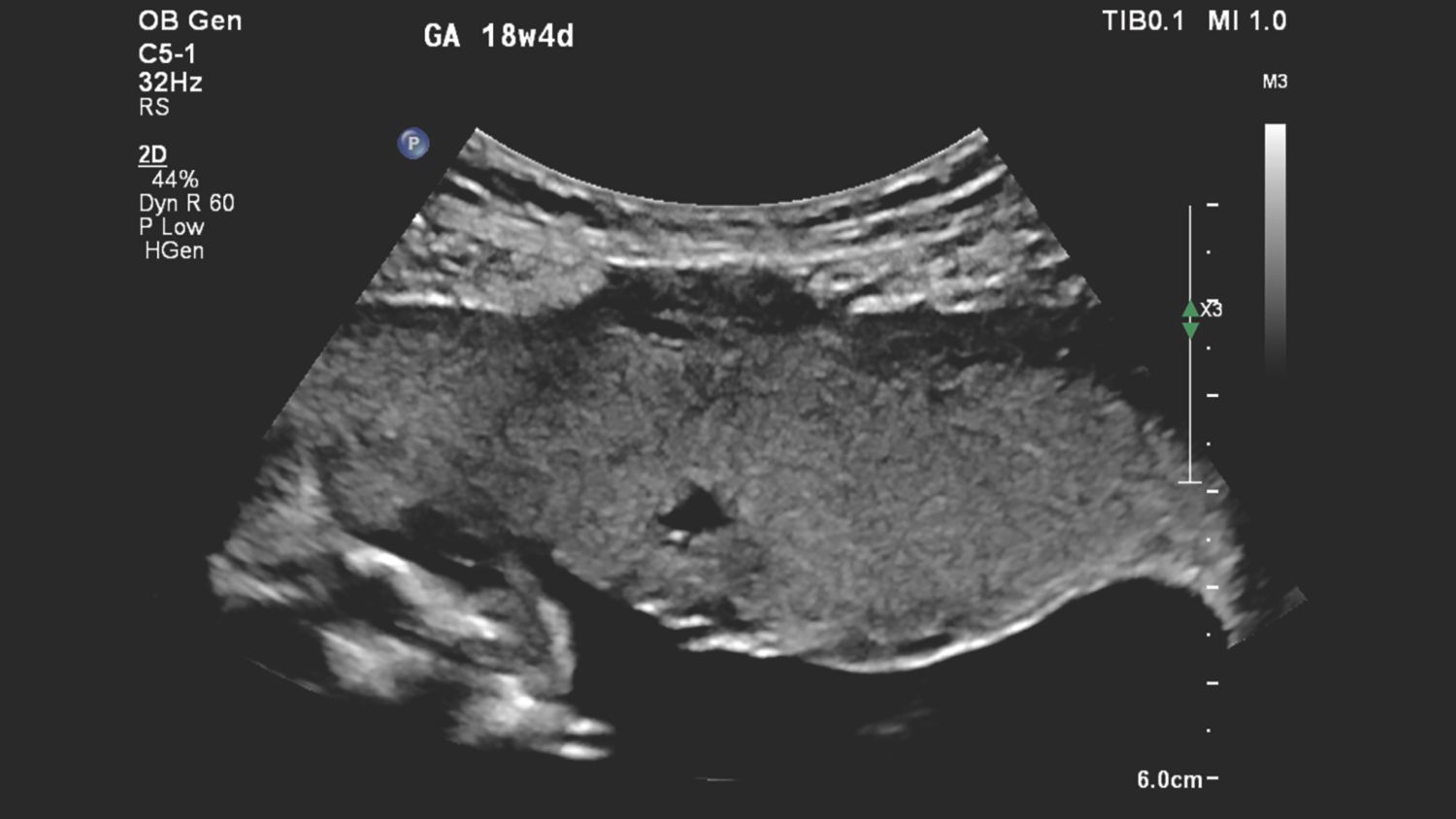 Figure 1 C5-1 transducer sagittal image of suspected placental abnormality