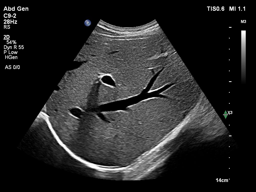 C9-2 scanning on a liver.