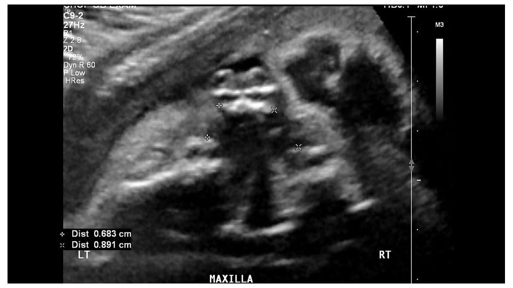 2D transverse view using the C9-2 transducer, measuring the bilateral defects in the alveolar ridge