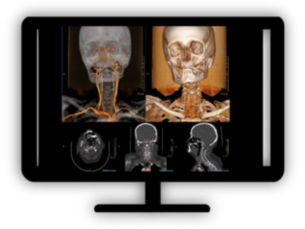 CT Advanced Vessel Analysis Pre-procedural Planning Quickly plan vascular access route for endovascular procedures and stent placement