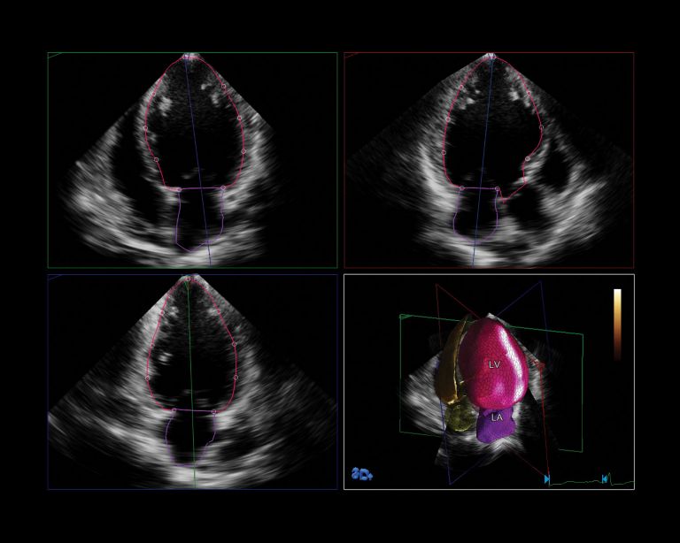Image clinique HeartModel
