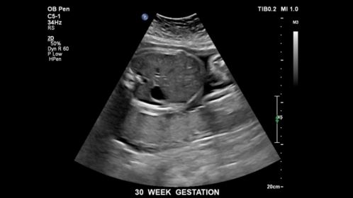 EPIQ ultrasound machine obstetric clinical image of a fetus at 30 weeks gestation