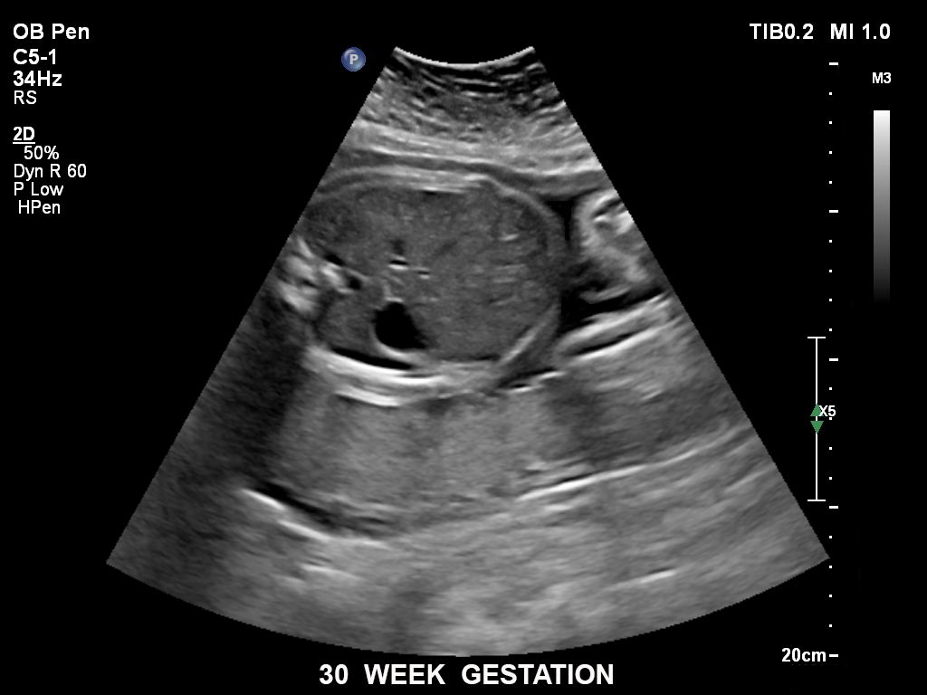 EPIQ ultrasound machine obstetric clinical image of a fetus at 30 weeks gestation