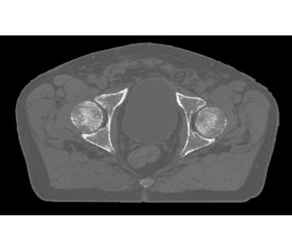 MRCAT Pelvis