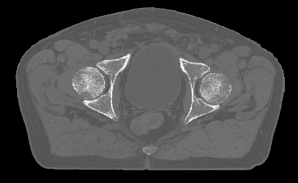 MRCAT Pelvis MR-RT clinical application
