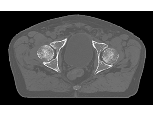 MRCAT Pelvis Application clinique de radiothérapie guidée par IRM