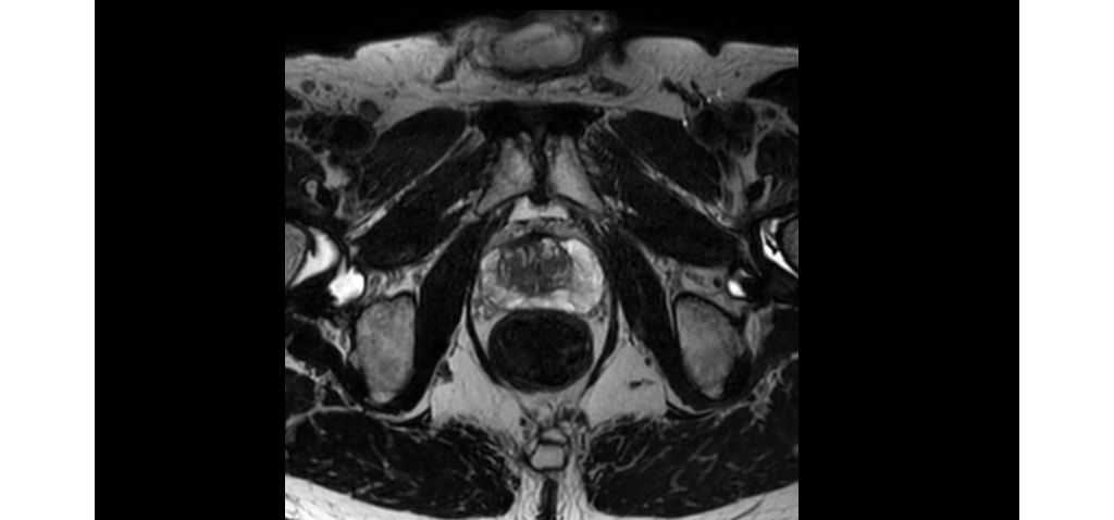 3D PelvisVIEW - Axial T2w TSE