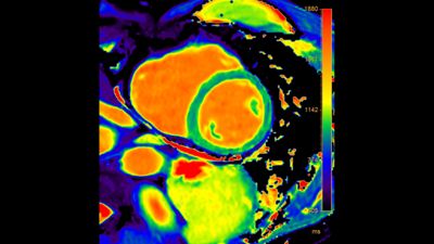 Philips - Smart Quant - Cardiac HCNMRF450A MR Clinical Applications ...