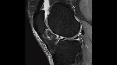 Sagittal T2w SPAIR - Knee