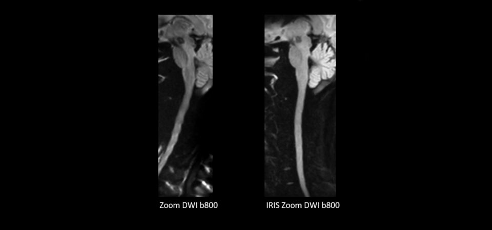 IRIS Zoom comparison