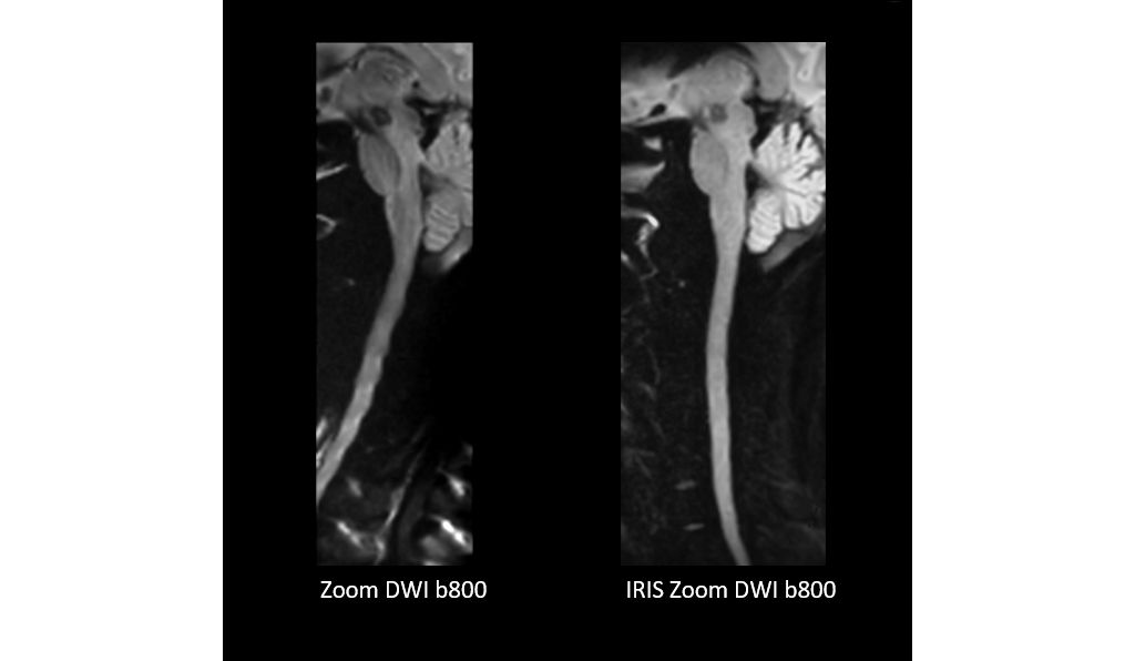 IRIS Zoom comparison