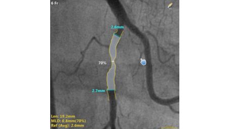 Quantitative coronary analysis