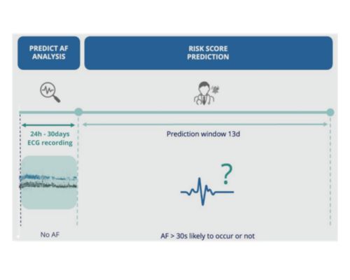 Prediction of AF from a sinus ECG