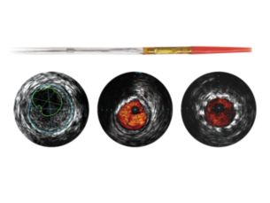 Visions PV .014P Digital IVUS catheter