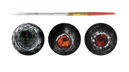 Philips - Visions PV .014P Digital IVUS catheter