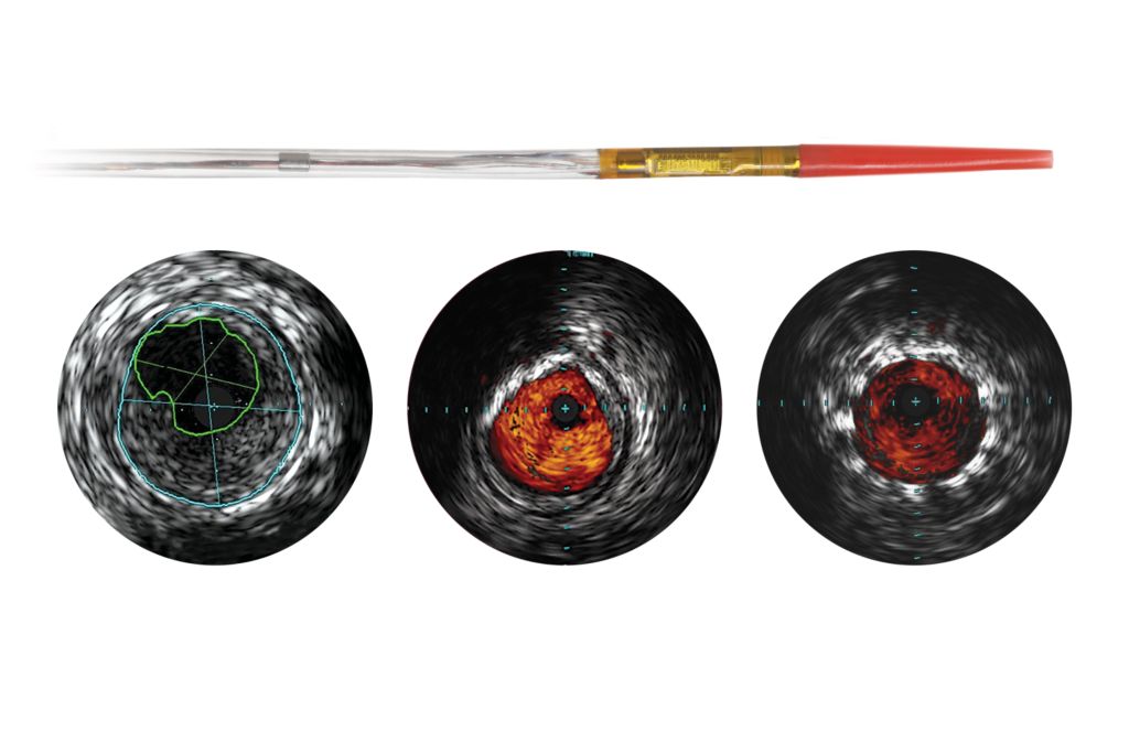 Standard Product Photo Philips Volcano Visions PV .014P RX Digital IVUS catheter