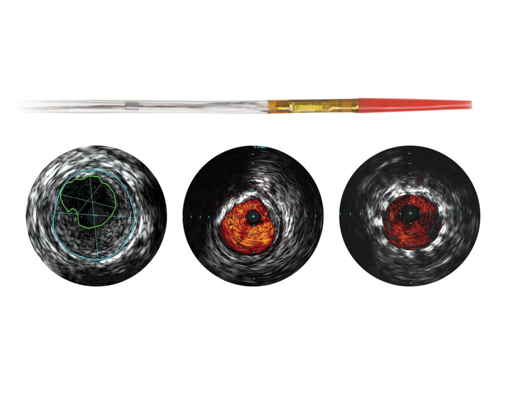 Visions PV .014P RX Digital IVUS catheter