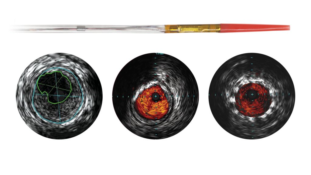 Visions PV .014P RX Digital IVUS catheter