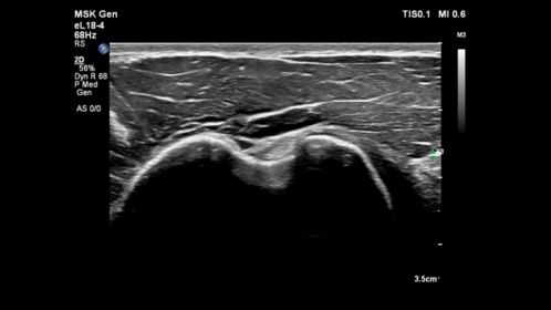eL18-4 transducer on shoulder & biceps tendon.