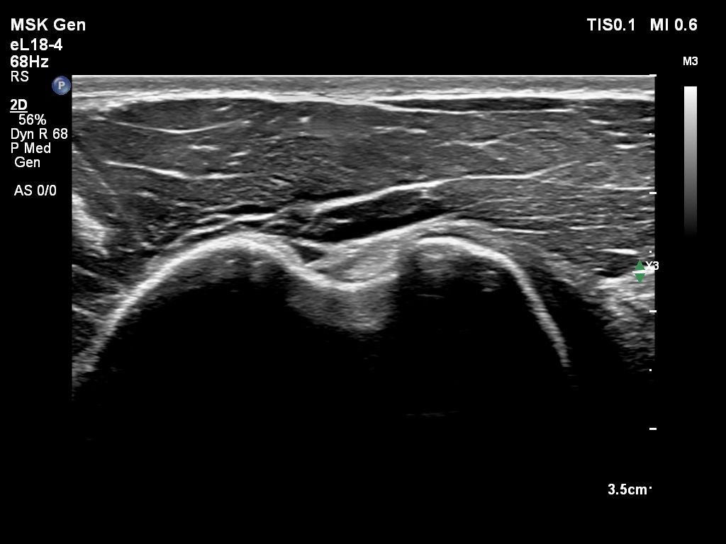 eL18-4 transducer on shoulder & biceps tendon.