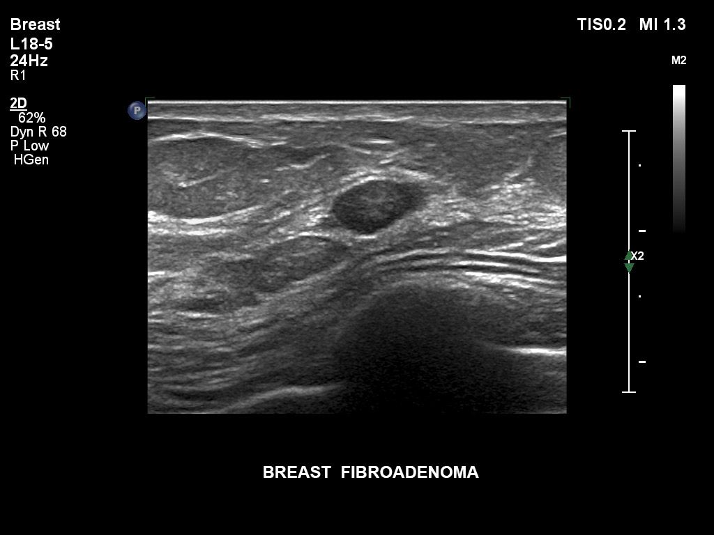 Breast fibroadenoma