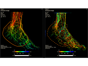 SmartPerfusion Imaging technology