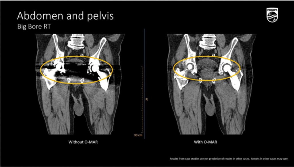 BBRT Abdomen and Pelvis with O-MAR