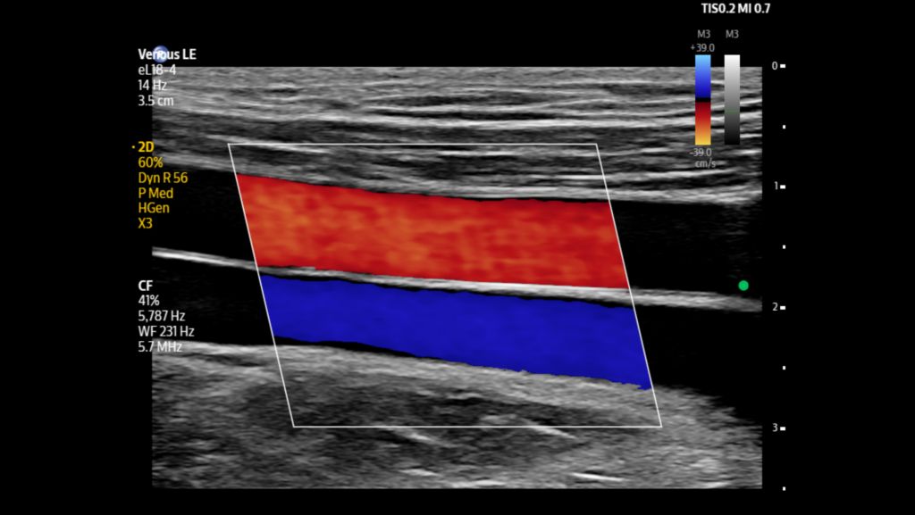 Venous superior femoral vessels shown using eL18-4 transducer with color.