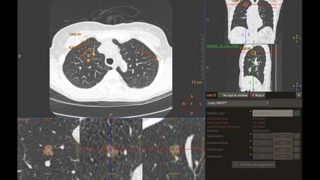 AI-based lung nodule detection