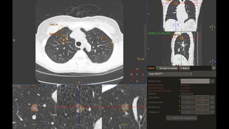 Detecção de nódulo pulmonar baseada em IA