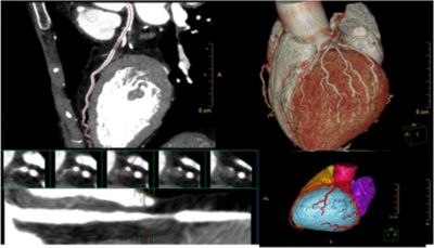 Workspace showing automated coronary calcium analysis on screen